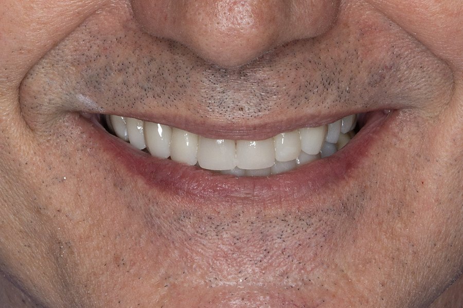 After full-mouth reconstruction at Yanes Dental — even, natural, full-length teeth at a restored bite