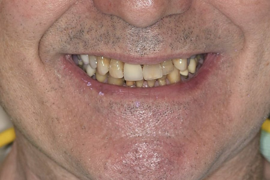 Before treatment at Yanes Dental — worn, shortened and discolored upper and lower teeth