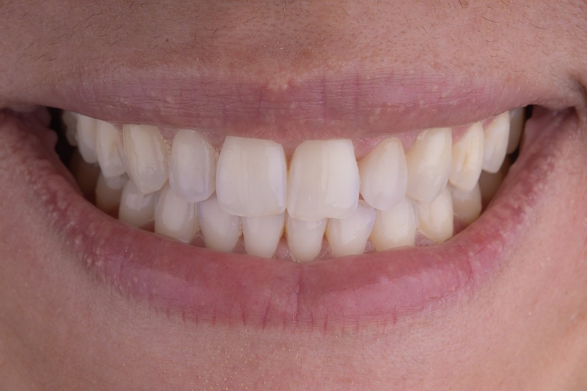 After a single porcelain veneer at Yanes Dental — the front teeth now even and symmetrical