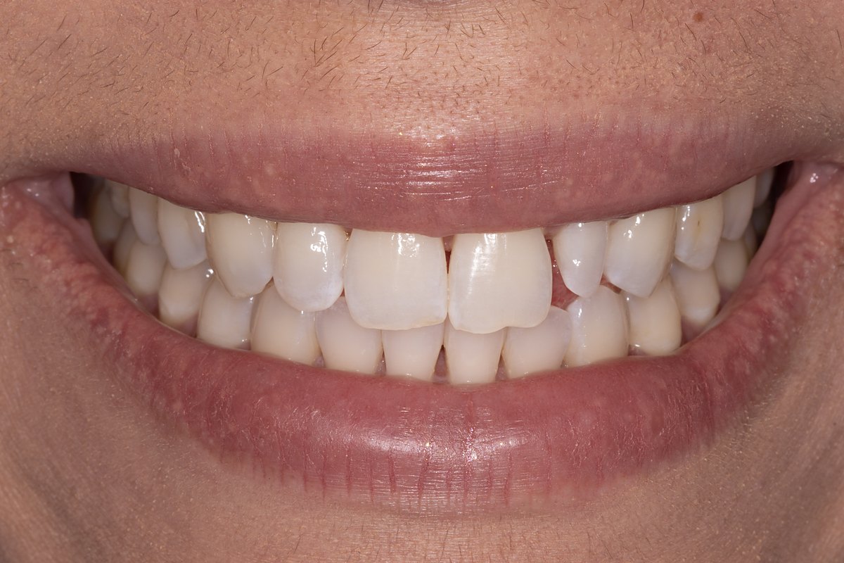 Before treatment at Yanes Dental — an undersized upper front tooth leaving a gap and an uneven smile line
