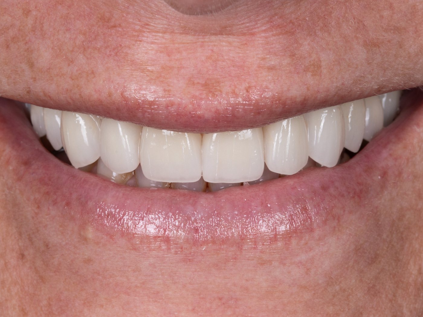 After treatment at Yanes Dental — upper front teeth restored to an even, natural smile line