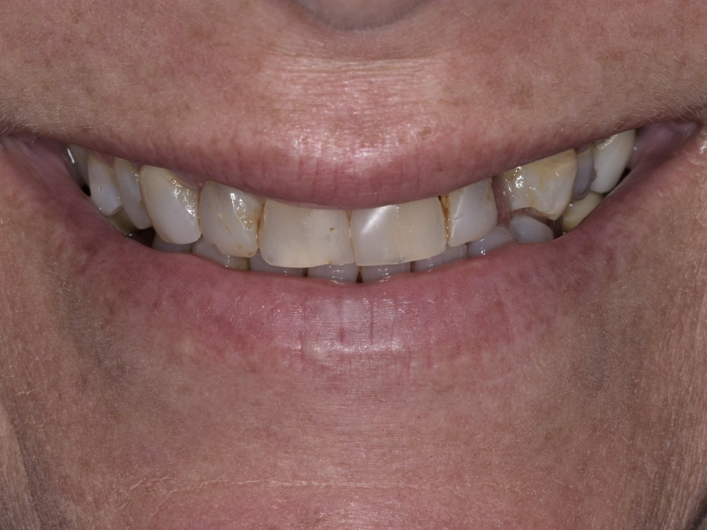 Before treatment at Yanes Dental — worn, chipped and mismatched upper front teeth